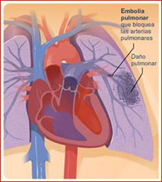 http://www.endovascular.es/img/Foto-embolia-pulmonar.jpg