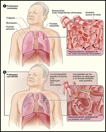 La figura A muestra la ubicación de los pulmones y las vías respiratorias en el cuerpo. En el recuadro se observa un corte transversal detallado de los bronquíolos y los alvéolos. La figura B muestra unos pulmones afectados por la EPOC. En el recuadro se observa un corte transversal detallado de los bronquíolos y las paredes alveolares que están lesionados por la enfermedad.
